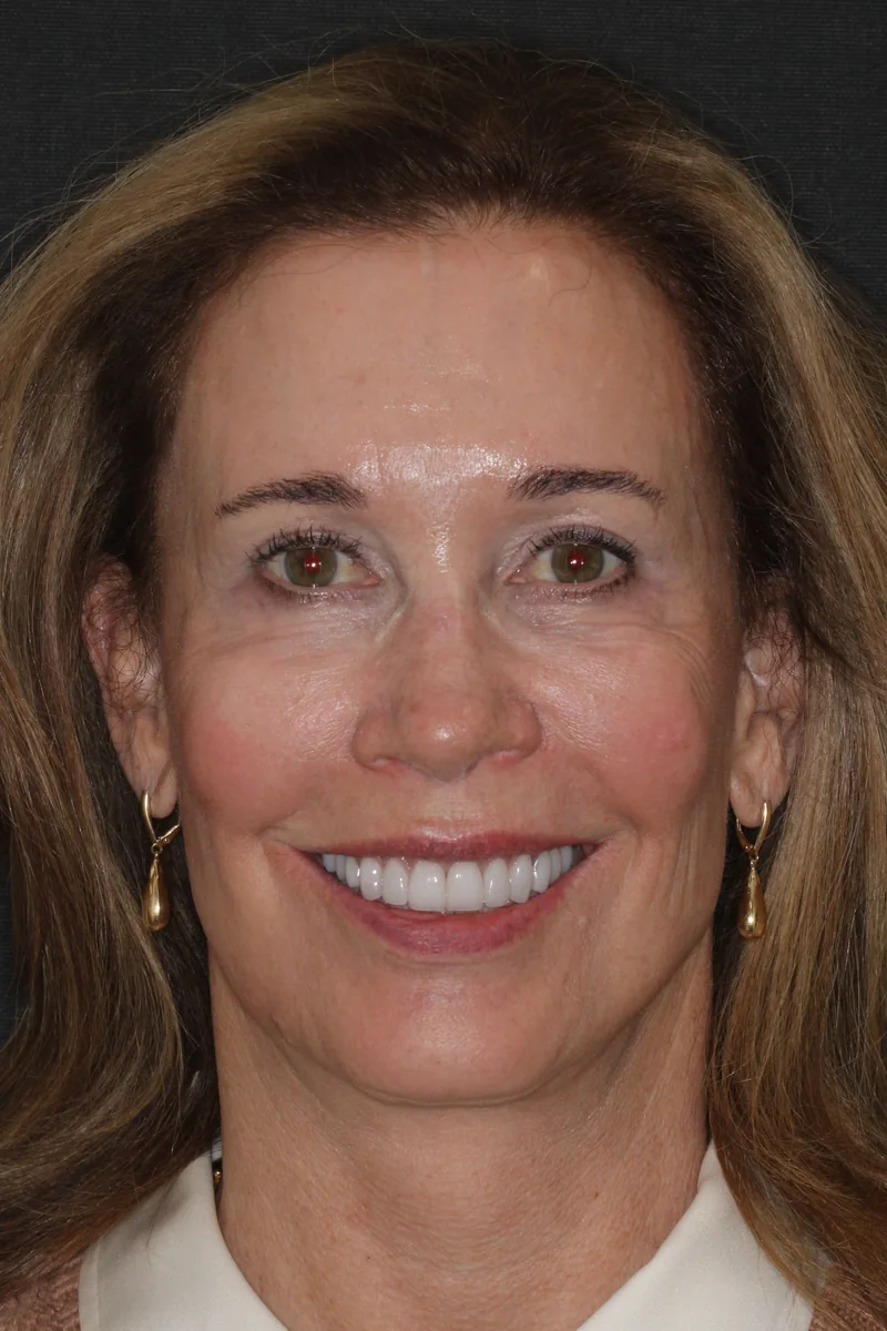 Featured patient after porcelain veneers and smile design full smile portrait