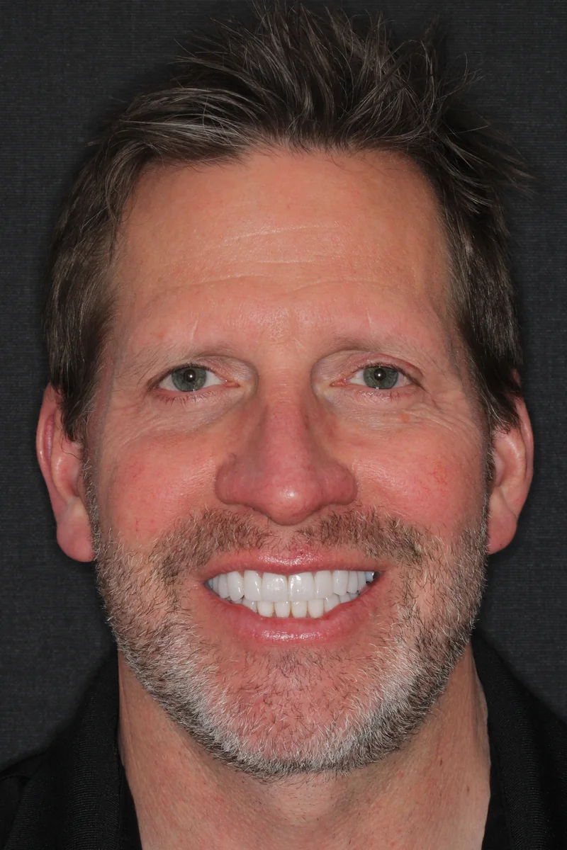 Featured patient after complete veneer restoration full smile portrait
