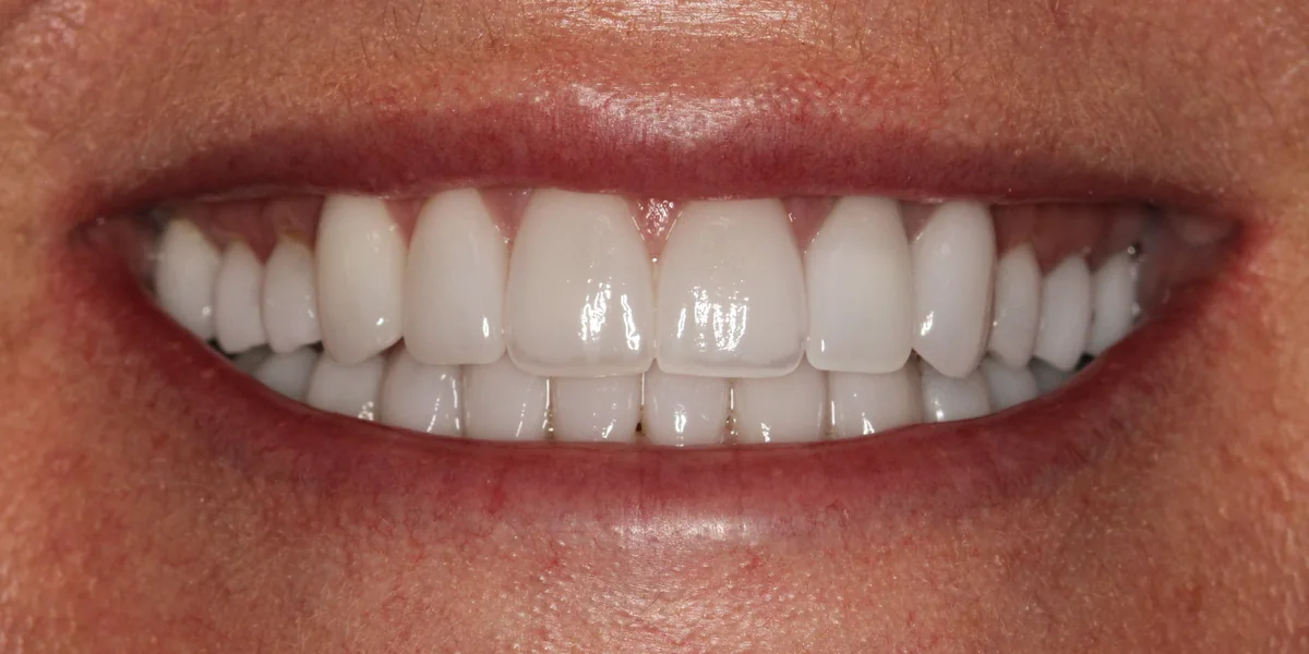 Featured patient after full arch veneers and bite restoration close-up smile result