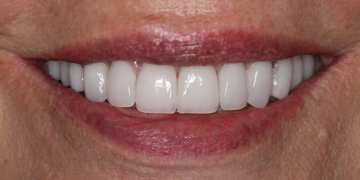 Featured patient after porcelain veneers and smile design close-up smile result