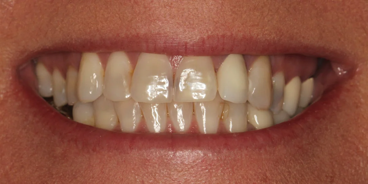 Featured patient before full arch veneers and bite restoration close-up smile condition