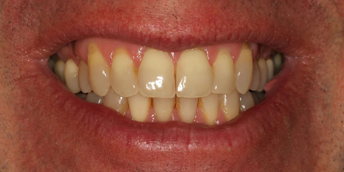 Featured patient before complete veneer restoration close-up smile condition